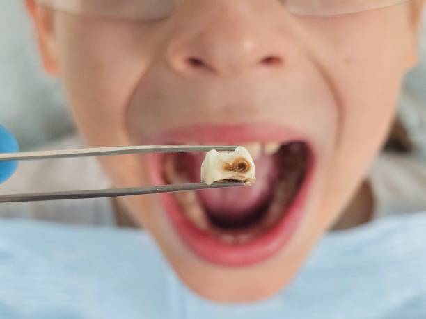 Best Emergency Tooth Extraction in Eminence, KY